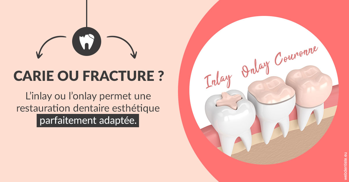 https://selarl-smile.chirurgiens-dentistes.fr/T2 2023 - Carie ou fracture 2