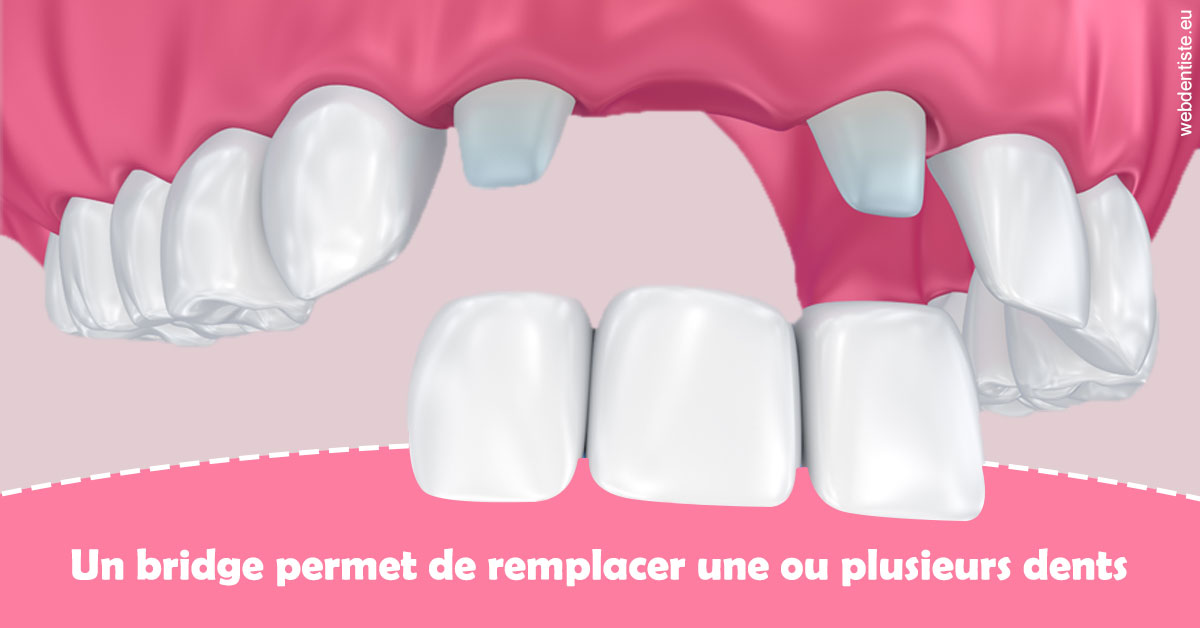 https://selarl-smile.chirurgiens-dentistes.fr/Bridge remplacer dents 2