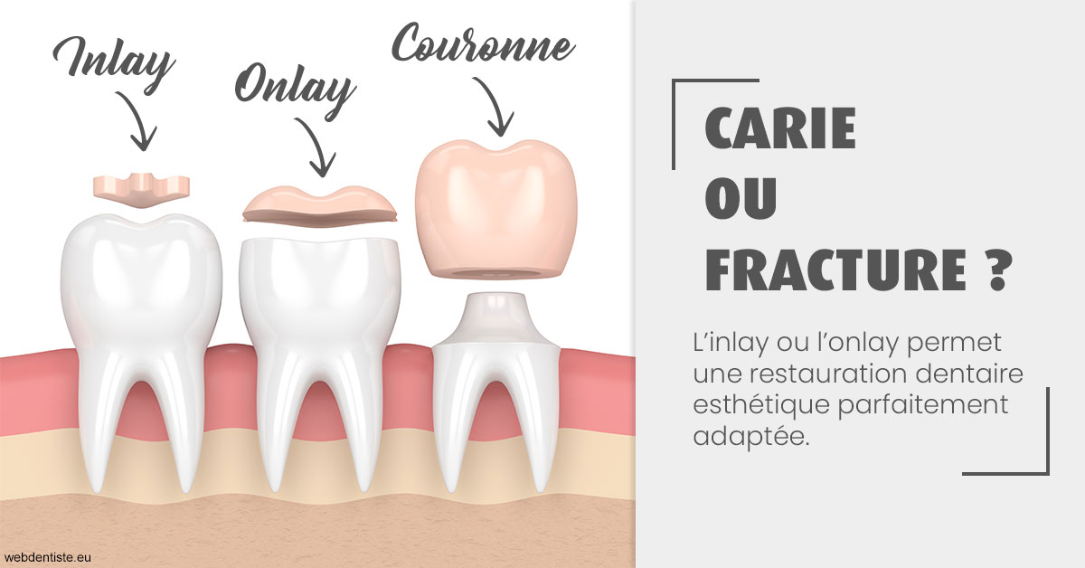 https://selarl-smile.chirurgiens-dentistes.fr/T2 2023 - Carie ou fracture 1
