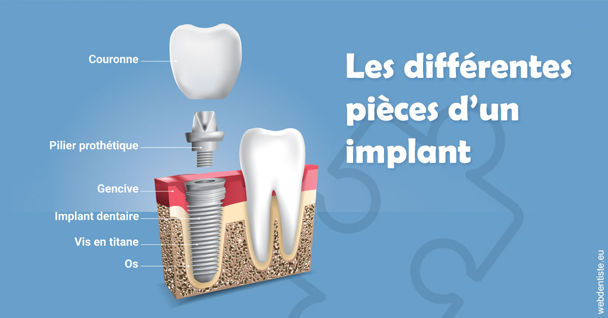 https://selarl-smile.chirurgiens-dentistes.fr/Les différentes pièces d’un implant 1